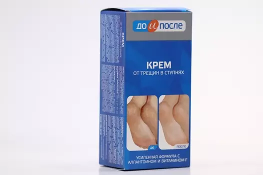 Крем от трещин в ступнях с аллантоином до и после, 150 мл