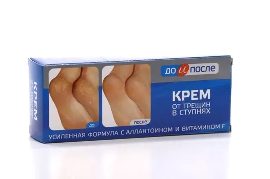 Крем TWINS Tec от трещин заживляющий в ступнях до и после, 50 мл