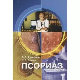 Псориаз
