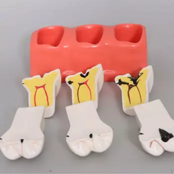 Sumulation Decay Tooth Model Demonstration Removable 4 Times Teaching Aid Educational Materials for