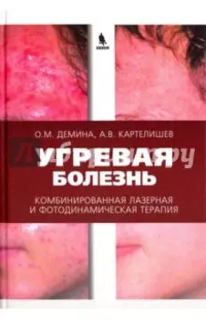 Угревая болезнь. Комбинированная лазерная и фотодинамическая терапия