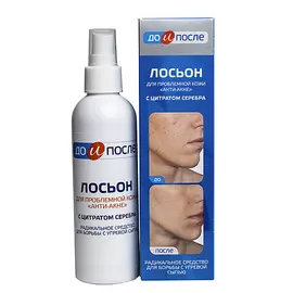 ДО И ПОСЛЕ Лосьон для проблемной кожи «Анти-Акне» с цитратом серебра 200.0