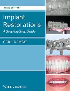 Implant Restorations. A Step-by-Step Guide
