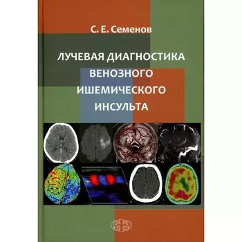 Лучевая диагностика венозного ишемического инсульта. Семенов С.Е.